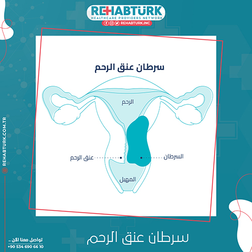 علاج سرطان عنق الرحم في تركيا