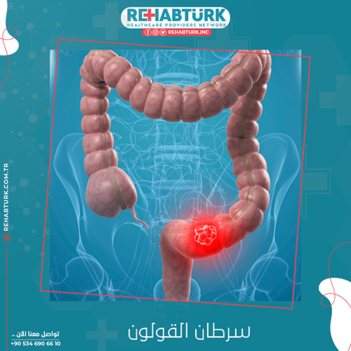 علاج سرطان القولون في تركيا شبكة ريهابتورك للعلاج في تركيا