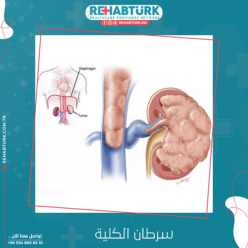 علاج سرطان الكلية في تركيا